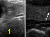 Mural Nodule Thyroid Pdf Mixed Echoic Thyroid Nodules On Ultrasound Approach to Management