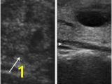 Mural Nodule Thyroid Pdf Mixed Echoic Thyroid Nodules On Ultrasound Approach to Management