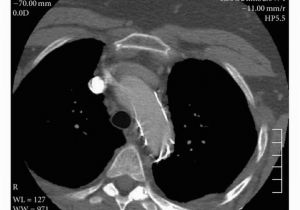 Mural Thrombus Treatment Angio Ct Scan Showing Follow Up One Year after Intervention